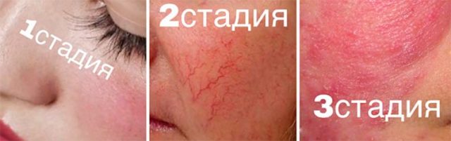 Сосудистые звездочки на лице — лечение в салоне, народными методами