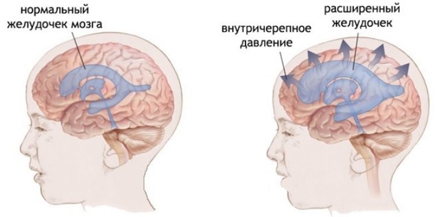 Гипертензионный синдром у детей и взрослых: симптомы, лечение