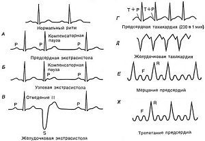 Регулярный и нерегулярный синусовый ритм сердца