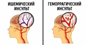 Последствия инсульта у мужчин и методы их реабилитации