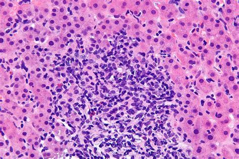 Соотношение аст и алт норма — Лечим печень