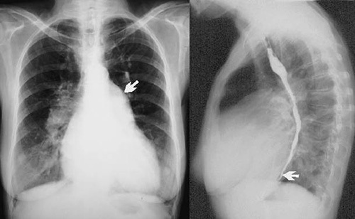 Анатомия сосудов легких. Легочная артерия