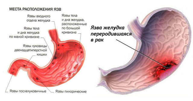 Как и чем повысить верхнее систолическое давление в домашних условиях? Низкое верхнее артериальное давление: причины и лечение