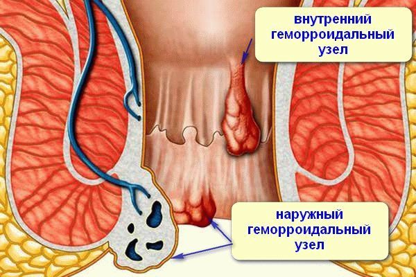 Узлы в прямой кишке - Геморроидальные узлы