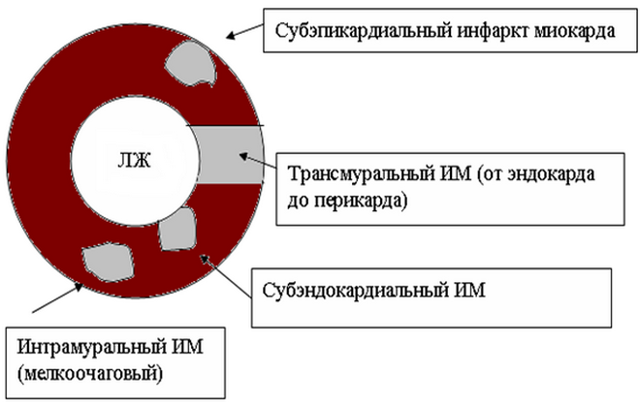 Инфаркт миокарда: что это такое, симптомы, лечение, последствия