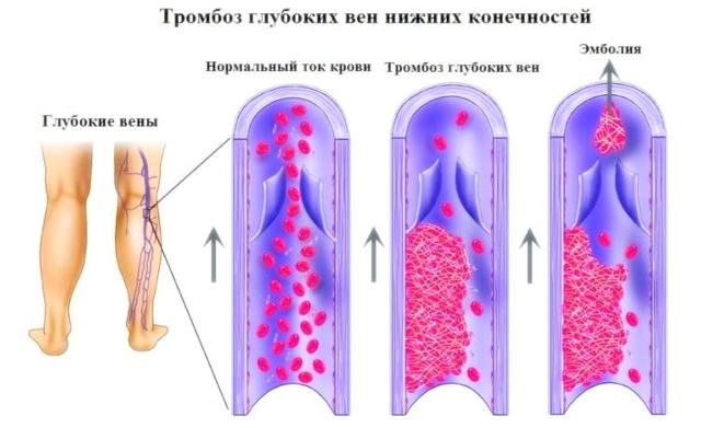 Гепариновая мазь - инструкция, применение, отзывы