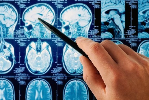 Киста сосудистого сплетения головного мозга: возникновение, диагностика, лечение. Опасна ли киста сосудистого сплетения для новорожденного?