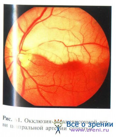Ишемические заболевания сетчатки глаза и зрительного нерва