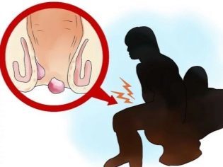 Геморрой при беременности - чем и как лечить геморрой беременной?