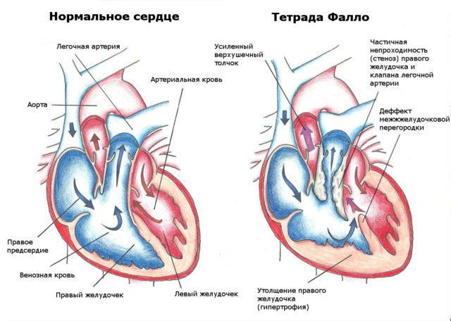 Тромб в сердце: что это такое, симптомы и что делать