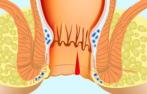 Глицериновые свечи от запора - свойства, применение