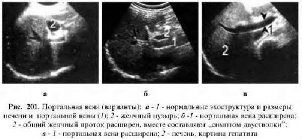 Воротная вена печени 9 мм - Лечение печени