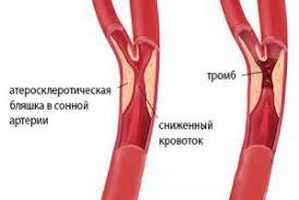Тромб в сонной артерии: лечение, симптомы и удаление