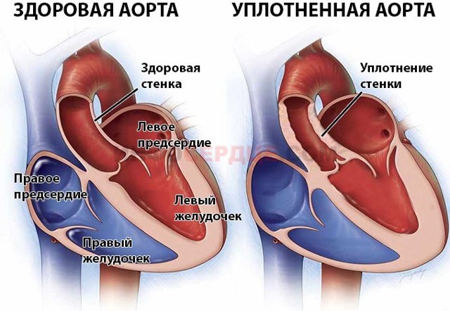 Аорта развернута что это значит. Аорта уплотнена и развернута что это