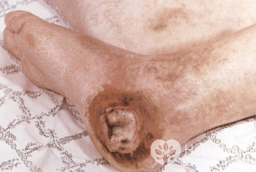 Что такое эндартериит - симптомы и лечение