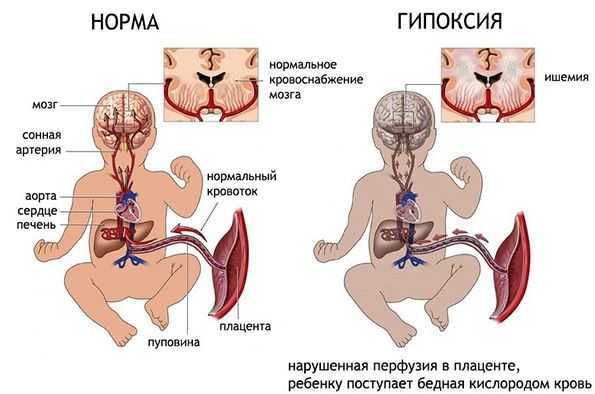 Артериальное давление 110 на 70: что это значит