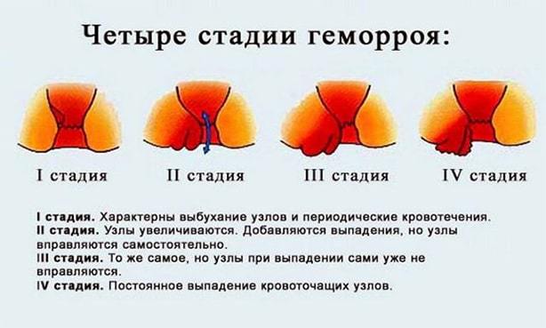 Может ли геморрой пройти сам, можно ли вылечить свечами полностью
