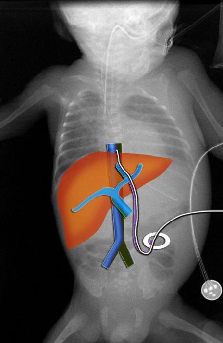 Повышен билирубин у взрослого или новорожденного - что это значит