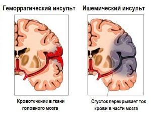 Ишемический инсульт: лечение и профилактика медикаментами