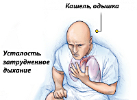 Сердечно легочная недостаточность: симптомы и лечение
