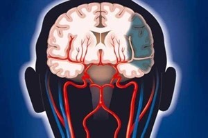 Нарушение венозного оттока головного мозга: причины, лечение
