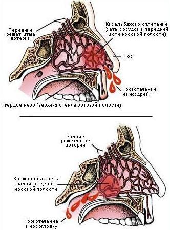 Когда идет кровь из носа что делать: неотложная помощь