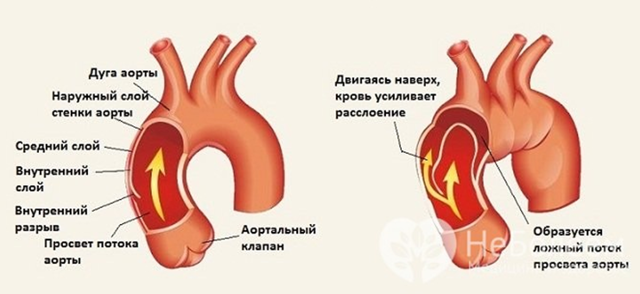 Питание при аневризма брюшной аорты -