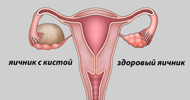 Фолликулярная киста яичника - симптомы, лечение, причины