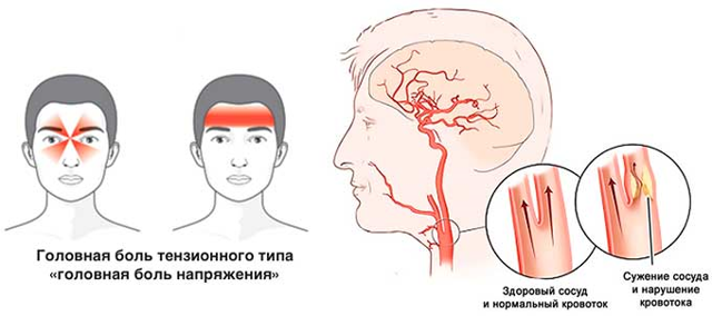 Цефалгия - причины, лечение, диагностика, классификация головной боли