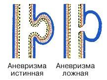 Аневризма бедренной артерии симптомы