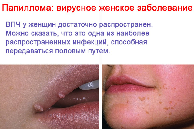 Вирус папилломы человека у женщин симптомы фото