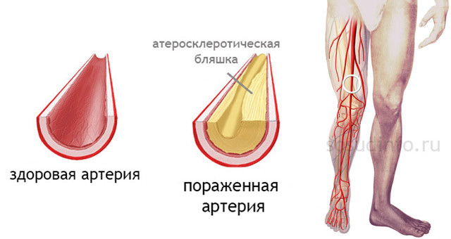 Симтомы, диагностика и лечение закупорки кровеносных сосудов