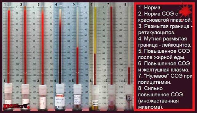 СОЭ анализ крови: норма и возможные отклонения