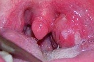 Паратонзиллярный абсцесс: лечение, фото, симптомы