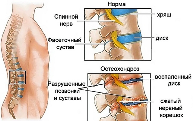 Терафлекс – инструкция по применению: описание и действие средства, аналоги и цена, отзывы о мази и капсулах