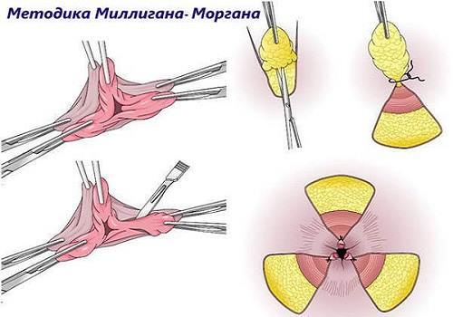 Диета после операции удаления геморроя: 9 основных принципов