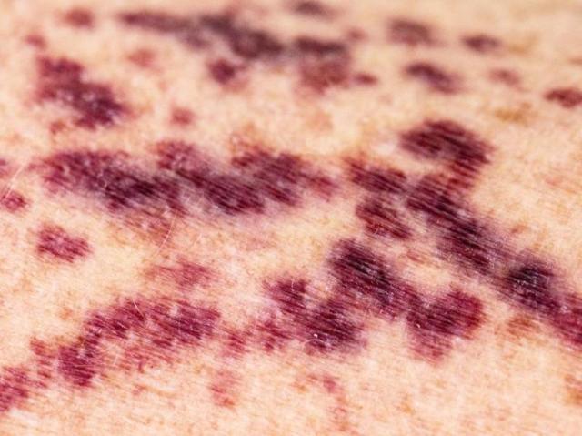 Викасол - таблетки и ампулы: цена и инструкция по применению лекарства