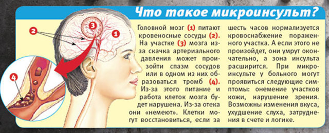 Микроинсульт – симптомы и последствия, признаки, лечение, или Берегите здоровье смолоду