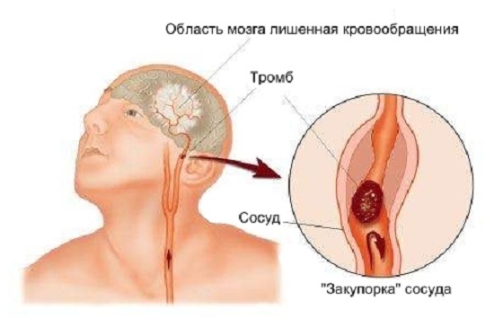 Ишемический инсульт - причины, симптомы, диагностика и лечение