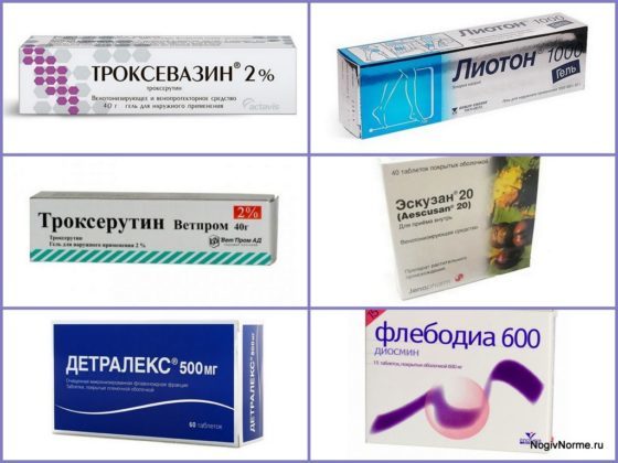 Отеки при варикозе - снимаем быстро и надолго
