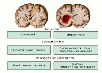 Ишемический инсульт головного мозга: прогноз для жизни у пожилых людей
