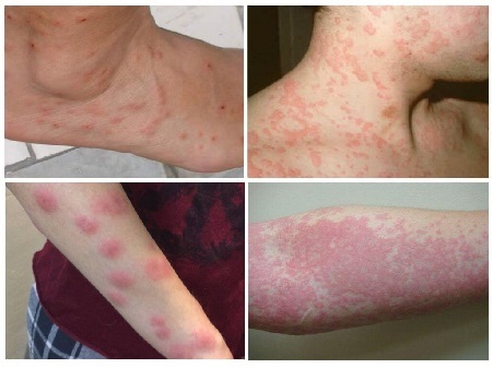 Красные пятна на теле у взрослого - появились красные пятнышки на лице