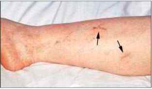 Осложнения и последствия после склеротерапии