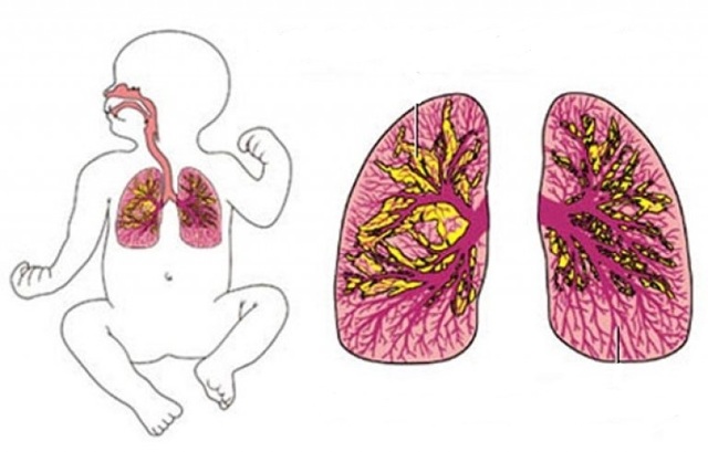 Бронхит при беременности, чем и как производить лечение у беременных на 1,2,3 триместре. Можно ли антибиотики на ранних сроках и последствия заболевания на начальных сроках беременности