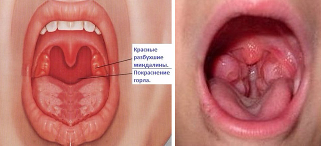 Тонзиллит: виды, фото, лечение и симптомы