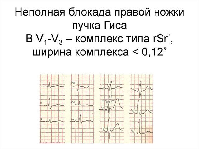 Чем опасна блокада ножек пучка гиса и как ее лечить