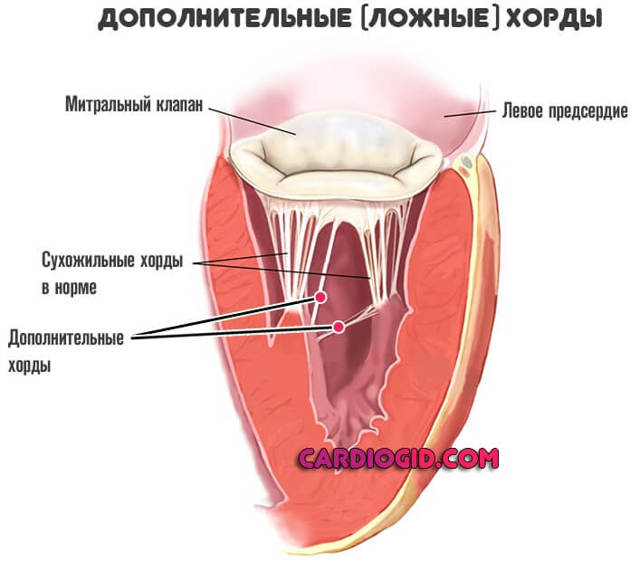 Дополнительная хорда в сердце у ребенка - что это такое и чем опасна?