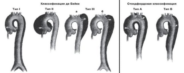 Расслоение аорты — Симптом Инфо