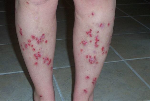 Трофические язвы нижних конечностей: виды, симптомы, лечение