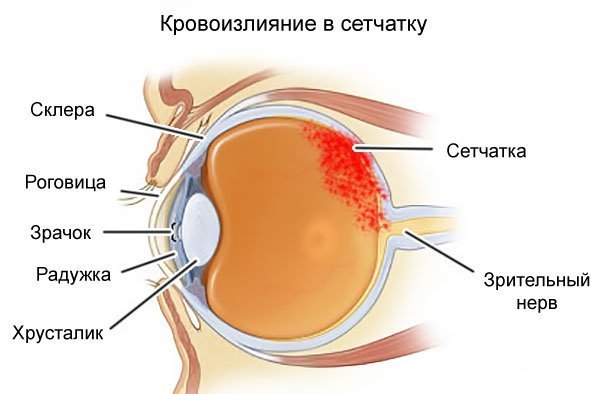 Кровоизлияние в глаз – причины, лечение, кровоизлияние после удара